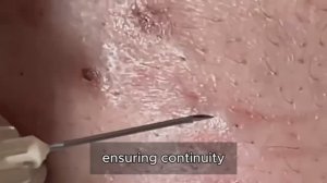 Техника безопасного выдавливания комедонов и черных точек. #𝟗𝟎446