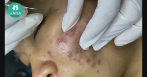 Профессиональное удаление прыщей у косметолога HANA #25