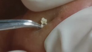 Чистка лица от угрей и акне. Выдавливание прыщей. Удаление черных точек и комедонов