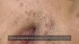 Профессиональное удаление открытых комедонов 90321