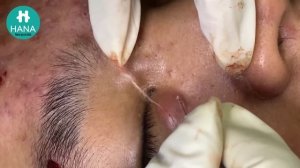 Убирание открытых комедонов и сужение пор: двойной эффект HANA #19