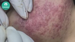 Лечим открытые комедоны (черные точки) HANA #07