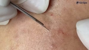 Избавляемся от закрытых комедонов GA