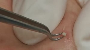 Чистка лица от угрей и акне. Выдавливание прыщей. Удаление черных точек и комедонов