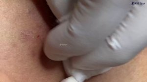 Профессиональное очищение кожи с прыщами. GA