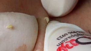 Выдавливание прыщей, угрей, черных точек и камедонов #223