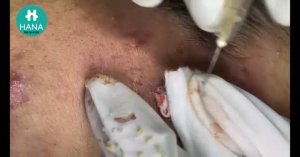 Глубокая чистка кожи от закрытых комедонов HANA #28