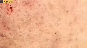 Жесткая чистка лица: глубокие комедоны и акне 2148