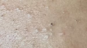 Глубокая чистка кожи лица от прыщей и черных точек #2181