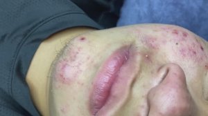 Asmr. Профессиональное очищение от угревой сыпи. #TT766