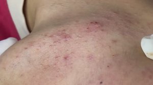 Удаление закрытых комедонов: процедура у косметолога. #TT779