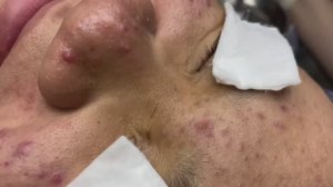 Asmr. Избавление от угревой сыпи. #TT765