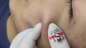 Asmr. Профессиональная чистка от угревой сыпи. #TT764