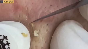 Жесткая чистка лица: глубокие комедоны и акне 2142