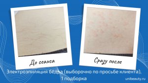 Электроэпиляция бедра, выборочно, 1 сеанс