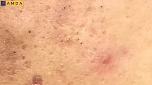 Глубокая чистка кожи лица от прыщей и черных точек #2141