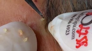 Asmr. Удаление черных точек. #TT778