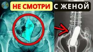 Никто бы не поверил, если бы это не сняли_ 20 ШОКИРУЮЩИХ находок внутри людей - Документальный фильм