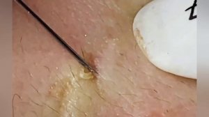 Выдавливание прыщей, угрей, черных точек и камедонов #227