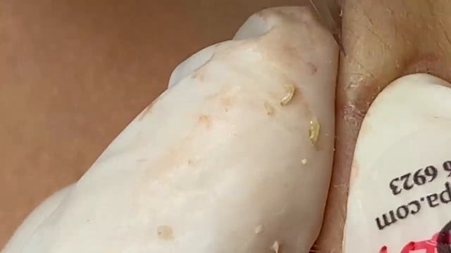 Выдавливание прыщей, угрей, черных точек и камедонов #228