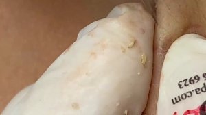 Выдавливание прыщей, угрей, черных точек и камедонов #228