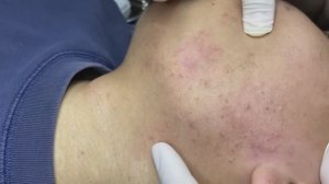 Профессиональное избавление от прыщей и следов постакне. #TT763