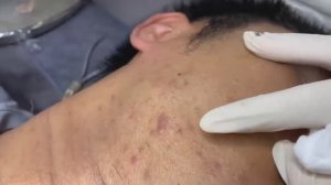 Лечение комедонов. Расслаблющее видео. #𝟗𝟎453