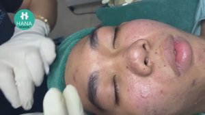 Asmr. Лечение угревой сыпи HANA #71