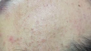 Asmr. Удаление черных точек. #TT778