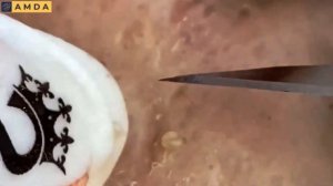 Жесткая чистка лица: глубокие комедоны и акне 2140