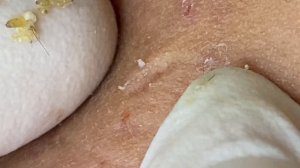 Лечение закрытых комедонов (белых угрей) #TT762