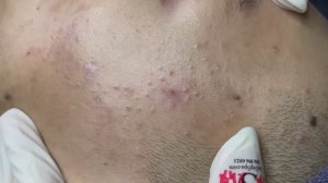 Чистка кожи от закрытых комедонов и выравнивание рельефа. #TT777