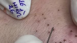 Глубокая чистка кожи лица от прыщей и черных точек #2173