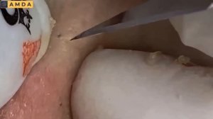 Глубокая чистка кожи лица от прыщей и черных точек #2175