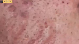 Жесткая чистка лица: глубокие комедоны и акне 2072