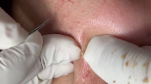 Выдавливание прыщей, угрей, черных точек и камедонов #229