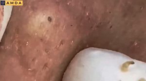 Глубокая чистка кожи лица от прыщей и черных точек #2161