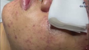 Удаление скрытых прыщей. Часть 1 GA