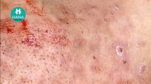 Asmr. Чистим кожу от угревой сыпи HANA #72