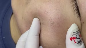 Asmr. Профессиональная чистка от угревой сыпи. #TT764