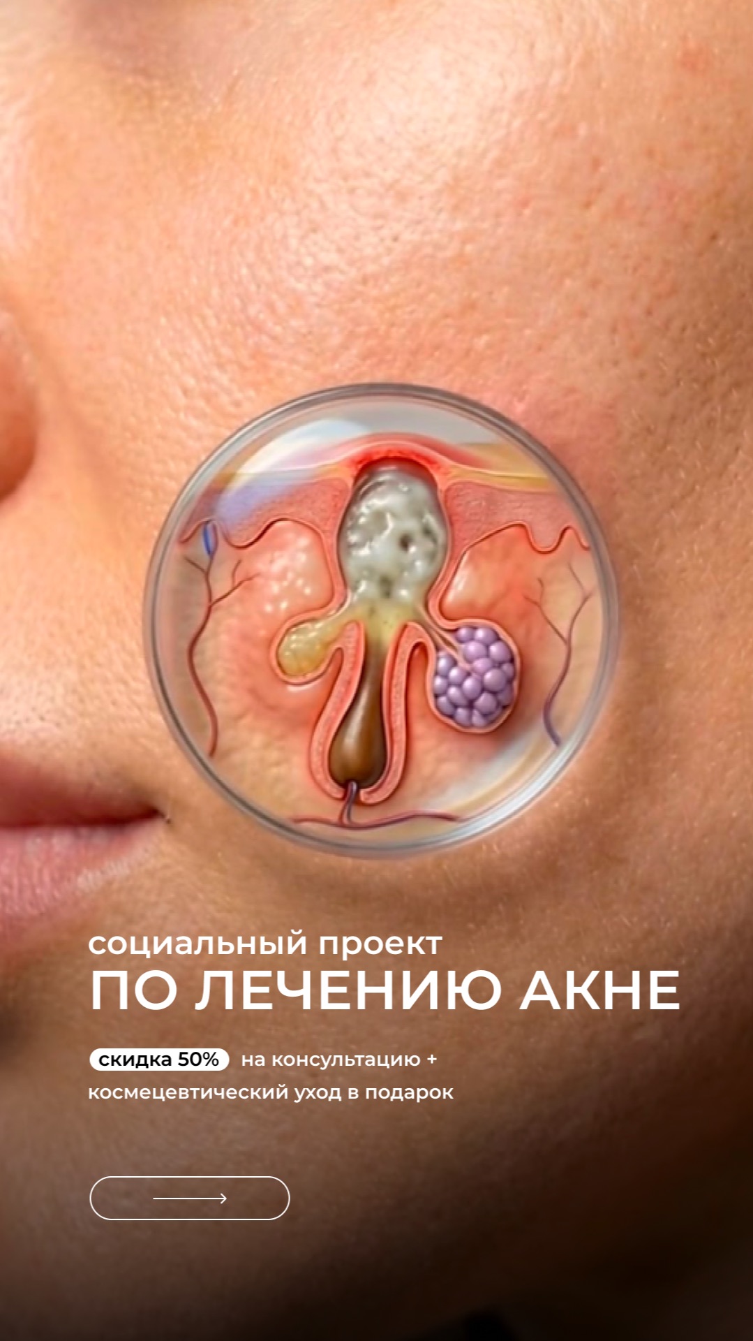 Социальный проект по лечению акне!