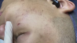 Asmr. Профессиональное удаление от угревой сыпи. #TT776