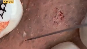 Глубокая чистка кожи лица от прыщей и черных точек #2171