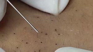 Глубокая чистка кожи лица от прыщей и черных точек #2175