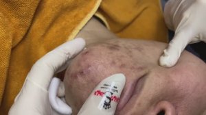 Asmr. Профессиональное очищение от угрей. #TT717