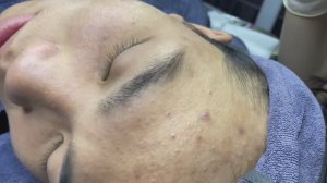 Asmr. Чистка лица от угревой сыпи. #ТТ715