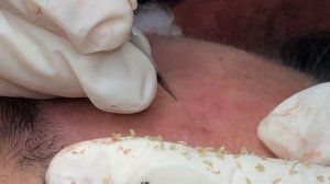 Удаление стержней закрытых комедонов в области лба ТТ#3