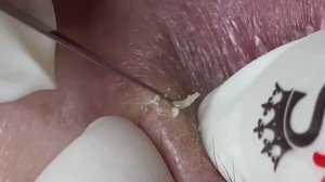 Лечение открытых комедонов (черных точек). Рабочая схема. #ТТ714