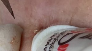 Asmr. Механическое очищение от угрей. #ТТ711