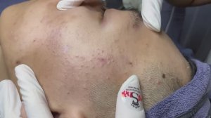 Asmr. Механическое очищение от белых точек. #ТТ710